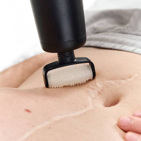 NOVAFON sound wave device with nubbed sensory roller attachment applied to the abdomen over surgical scarring